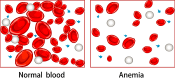 anemic blood